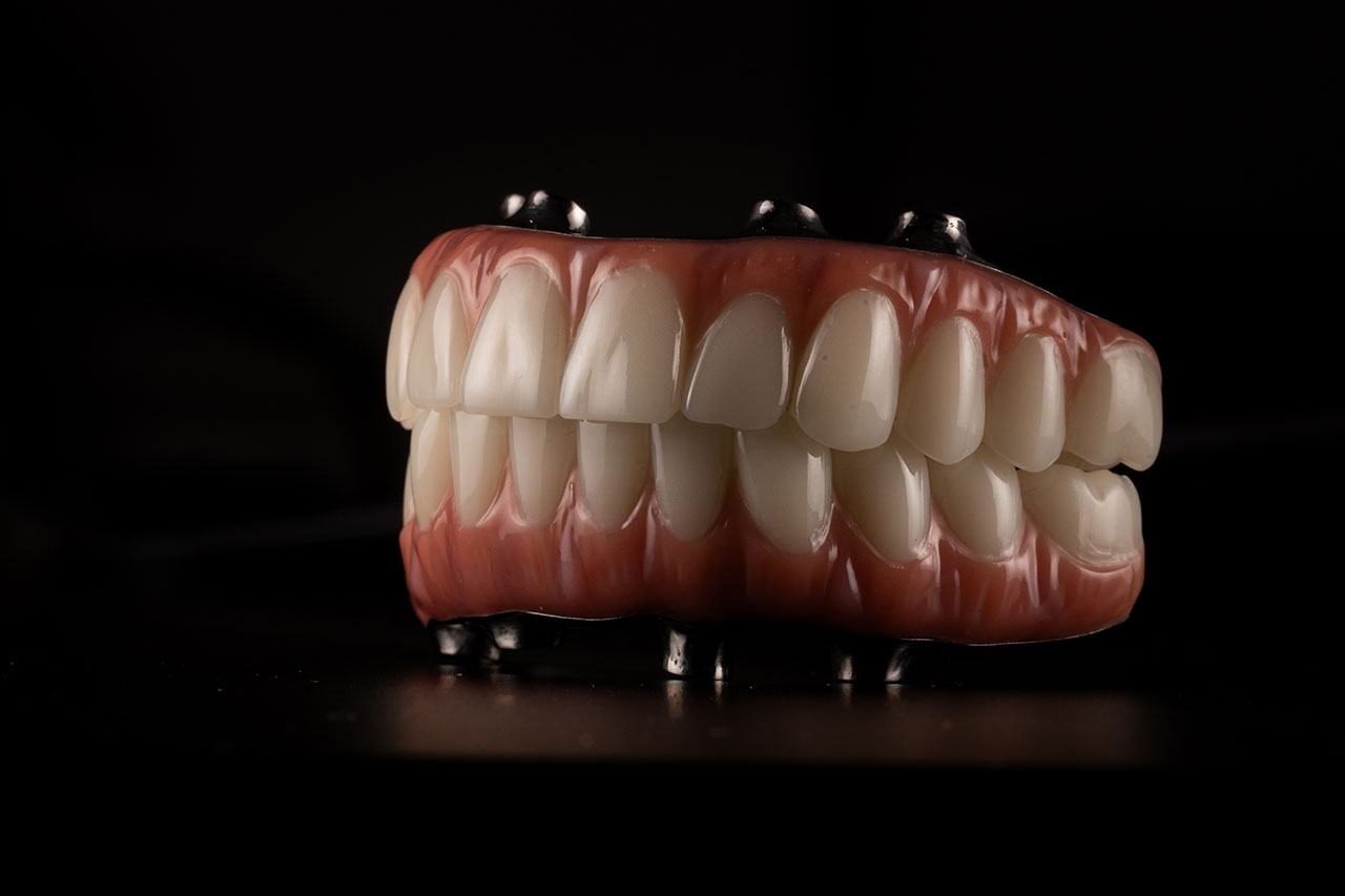 Full Mouth Reconstruction: Rebuilding Function, Comfort, and Confidence from the Ground Up